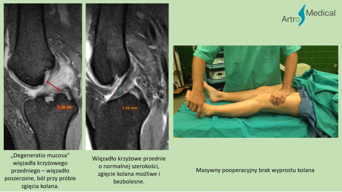 Ograniczenie ruchu kolana &ndash; przyczyny i leczenie przykurczow