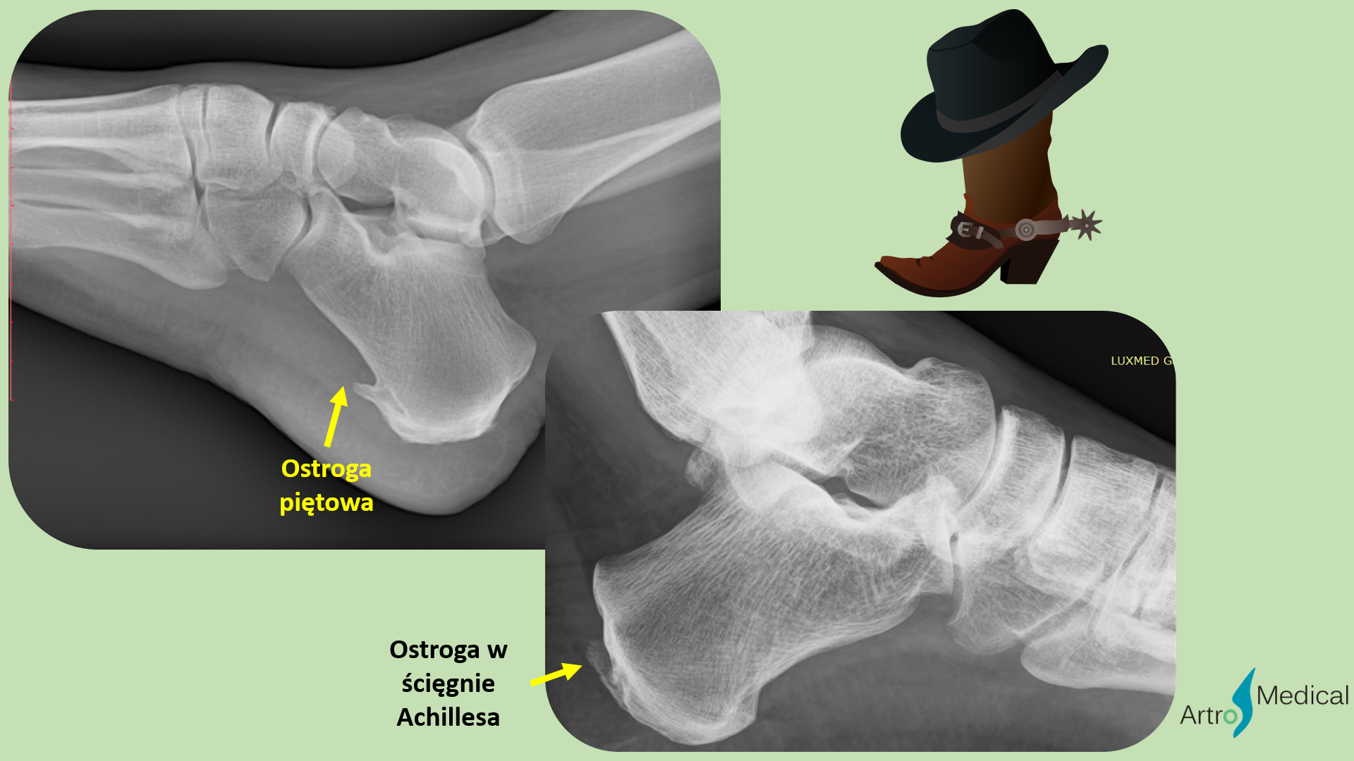 Ostroga piętowa &ndash; przyczyny, objawy i metody leczenia