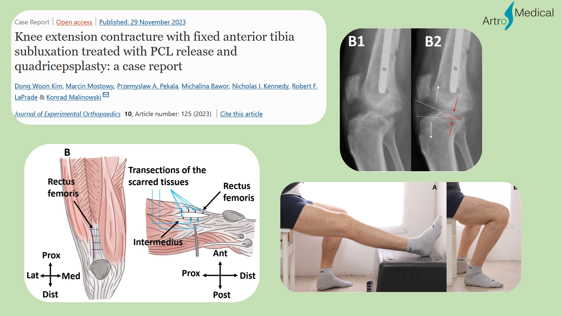 Przeciecie wiezadla krzyzowego tylnego - niezwykly przypadek kliniczny