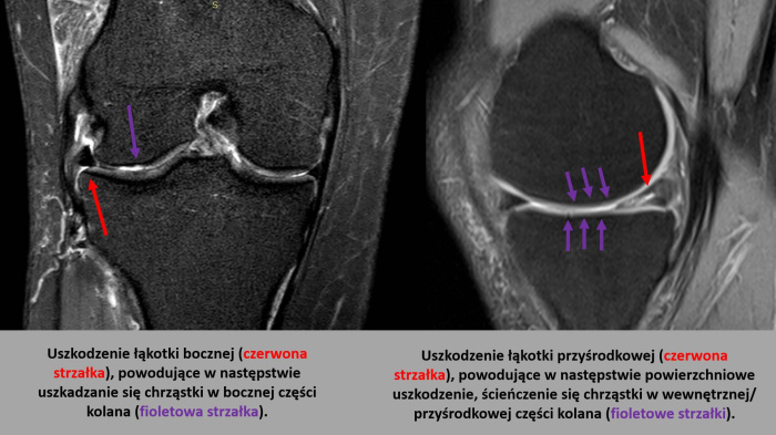 Uszkodzenia lakotek - dlaczego warto je naprawiac?