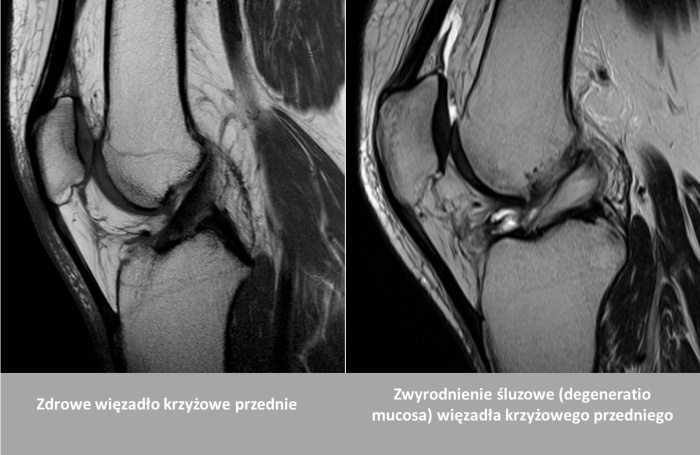 Uszkodzenia wiezadel krzyzowych - leczenie i powrot do aktywnosci