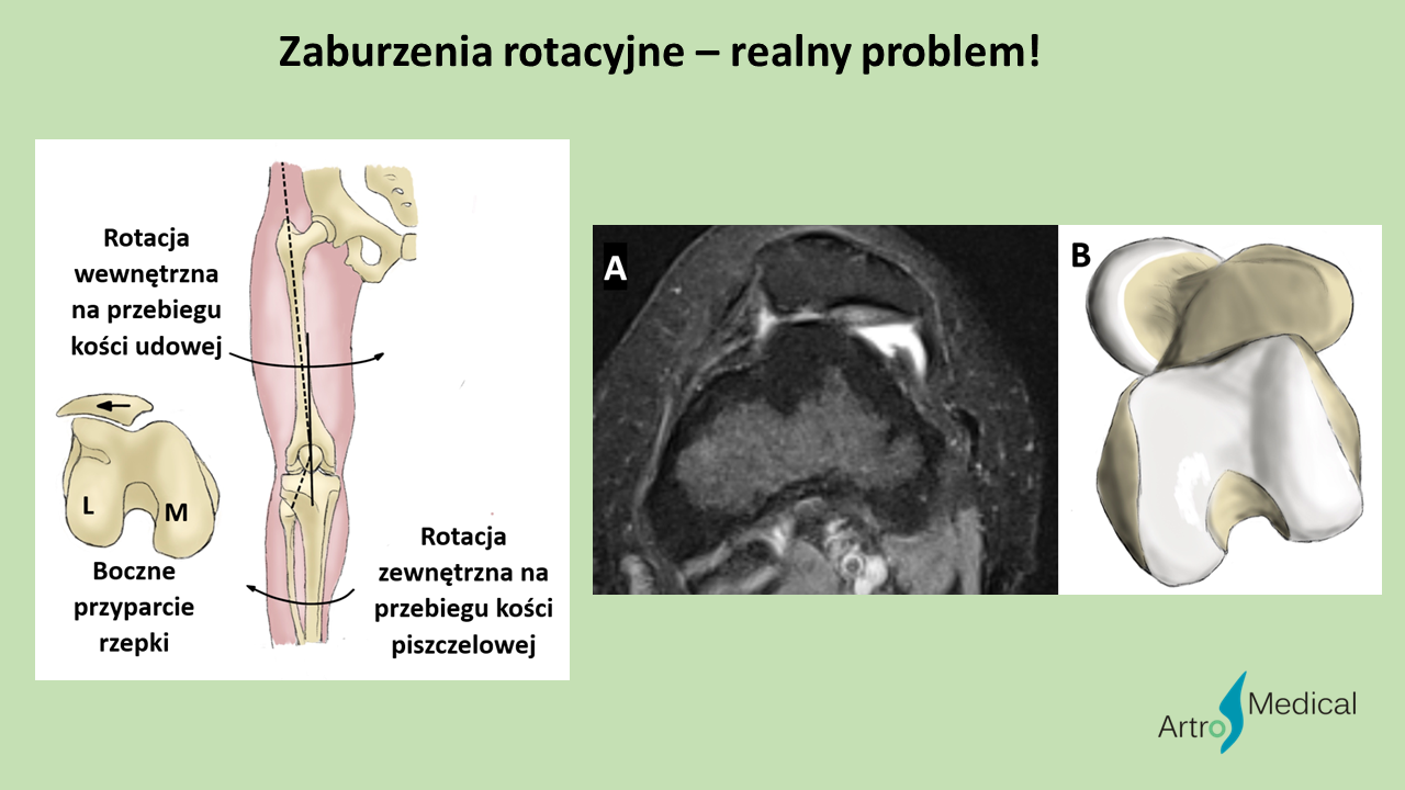 Zaburzenia rotacyjne kości długich &ndash; przyczyny i diagnostyka